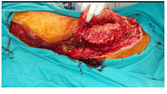 Vacuum-assisted closure in the treatment of biliary leakage following gunshot injury to the liver