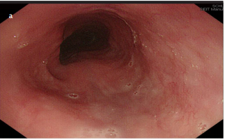Endoscopic resection using argon plasma coagulation for treating esophageal mucosal bridge in a patient with acquired immunodeficiency syndrome