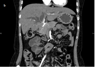 Primary hepatic tuberculosis masquerading as cholangiocarcinoma: A clinical nugget