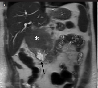 Endobiliary radiofrequency ablation and percutaneous biliary stent placement for choledocal invasion of renal cell carcinoma
