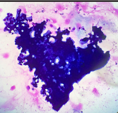 Should pancreas cyst fluids be divided into two for cytological diagnosis and biochemical tests?
