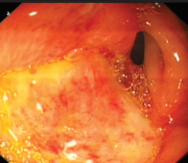 Rare cause of severe hematemesis due to IgG4-related gastric ulcer