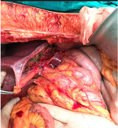 Giant hepatic hemangioma: An unusual cause of gastric compression