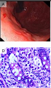 Report of two cases and a systematic review of breast cancer with gastrointestinal metastasis