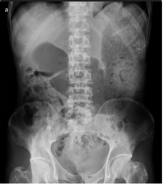 An unusual cause of recurrent vomiting