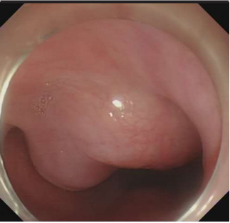 Submucosal tunneling endoscopic resection for large symptomatic submucosal tumors of the esophagus: A clinical analysis of 24 cases