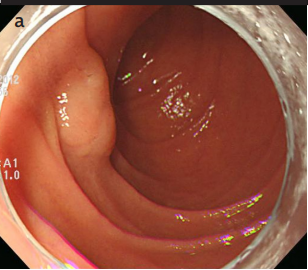 Long-term outcomes of endoscopic resection for non-ampullary duodenal epithelial tumors: A single-center experience