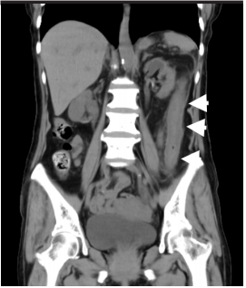 A rare cause of abdominal pain with bloody stool