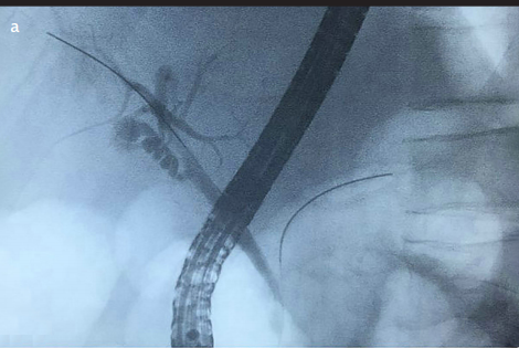 Dramatic imaging changes of a biliary stricture within 8 months in a rare case