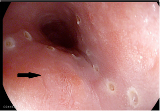 A tiny lesion arising within Barrett’s esophagus
